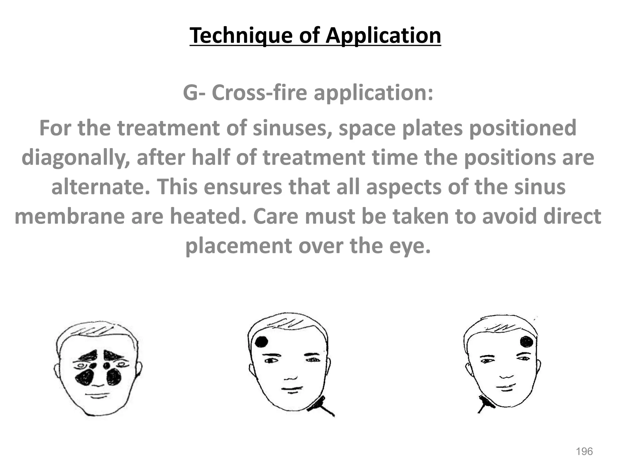 Technique of Application
G- Cross-fire application:
For the treatment of sinuses, space plates positioned
diagonally, after half of treatment time the positions are
alternate. This ensures that all aspects of the sinus
membrane are heated. Care must be taken to avoid direct
placement over the eye.
196
 