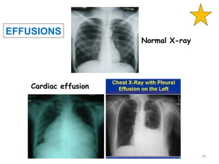 Normal X-ray
Cardiac effusion
EFFUSIONS
71
 