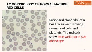 1.2 MORPHOLOGY OF NORMAL MATURE
RED CELLS
10
Peripheral blood film of a
healthy subject showing
normal red cells and
platelets. The red cells
show little variation in size
and shape
 