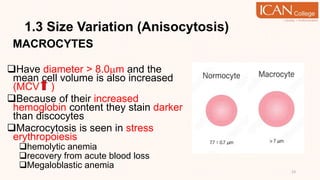 1.3 Size Variation (Anisocytosis)
MACROCYTES
Have diameter > 8.0m and the
mean cell volume is also increased
(MCV )
Because of their increased
hemoglobin content they stain darker
than discocytes
Macrocytosis is seen in stress
erythropoiesis
hemolytic anemia
recovery from acute blood loss
Megaloblastic anemia
13
 