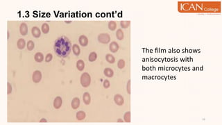 1.3 Size Variation cont’d
14
The film also shows
anisocytosis with
both microcytes and
macrocytes
 