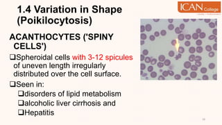 1.4 Variation in Shape
(Poikilocytosis)
ACANTHOCYTES ('SPINY
CELLS')
Spheroidal cells with 3-12 spicules
of uneven length irregularly
distributed over the cell surface.
Seen in:
disorders of lipid metabolism
alcoholic liver cirrhosis and
Hepatitis
18
 