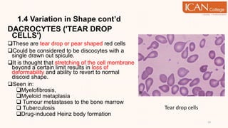 1.4 Variation in Shape cont’d
DACROCYTES ('TEAR DROP
CELLS')
These are tear drop or pear shaped red cells
Could be considered to be discocytes with a
single drawn out spicule.
It is thought that stretching of the cell membrane
beyond a certain limit results in loss of
deformability and ability to revert to normal
discoid shape.
Seen in:
Myelofibrosis,
Myeloid metaplasia
 Tumour metastases to the bone marrow
 Tuberculosis
Drug-induced Heinz body formation
19
Tear drop cells
 