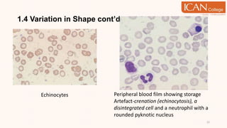 1.4 Variation in Shape cont’d
22
Echinocytes Peripheral blood film showing storage
Artefact-crenation (echinocytosis), a
disintegrated cell and a neutrophil with a
rounded pyknotic nucleus
 