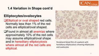 1.4 Variation in Shape cont’d
Elliptocytes/ovalocytes
Elliptical or oval shaped red cells.
Normally less than 1% of the red
cells are elliptical/oval shaped.
Found in almost all anemias where
approximately 10% of the red cells
may assume elliptical/oval shape
and in hereditary elliptocytosis
where almost all the red cells are
elliptical.
23
Peripheral blood film of a patient with
hereditary elliptocytosis showing elliptocytes
and ovalocytes
 