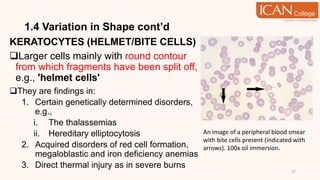 1.4 Variation in Shape cont’d
KERATOCYTES (HELMET/BITE CELLS)
Larger cells mainly with round contour
from which fragments have been split off,
e.g., 'helmet cells'
They are findings in:
1. Certain genetically determined disorders,
e.g.,
i. The thalassemias
ii. Hereditary elliptocytosis
2. Acquired disorders of red cell formation,
megaloblastic and iron deficiency anemias
3. Direct thermal injury as in severe burns
27
An image of a peripheral blood smear
with bite cells present (indicated with
arrows). 100x oil immersion.
 