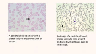 An image of a peripheral blood
smear with bite cells present
(indicated with arrows). 100x oil
immersion.
A peripheral blood smear with a
blister cell present (shown with an
arrow).
 