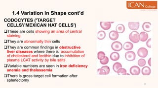 1.4 Variation in Shape cont’d
CODOCYTES ('TARGET
CELLS'/'MEXICAN HAT CELLS')
These are cells showing an area of central
staining
They are abnormally thin cells
They are common findings in obstructive
liver diseases where there is accumulation
of cholesterol and lecithin due to inhibition of
plasma LCAT activity by bile salts
Variable numbers are seen in iron deficiency
anemia and thalassemia
There is gross target cell formation after
splenectomy
29
 