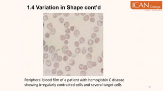 1.4 Variation in Shape cont’d
30
Peripheral blood film of a patient with hemoglobin C disease
showing irregularly contracted cells and several target cells
 