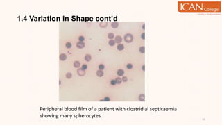 1.4 Variation in Shape cont’d
33
Peripheral blood film of a patient with clostridial septicaemia
showing many spherocytes
 