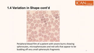 1.4 Variation in Shape cont’d
34
Peripheral blood film of a patient with severe burns showing
spherocytes, microspherocytes and red cells that appear to be
budding off very small spherocytic fragments
 