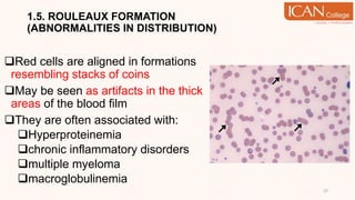 1.5. ROULEAUX FORMATION
(ABNORMALITIES IN DISTRIBUTION)
Red cells are aligned in formations
resembling stacks of coins
May be seen as artifacts in the thick
areas of the blood film
They are often associated with:
Hyperproteinemia
chronic inflammatory disorders
multiple myeloma
macroglobulinemia
37
 