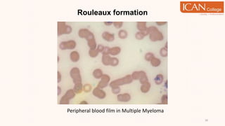 Rouleaux formation
38
Peripheral blood film in Multiple Myeloma
 