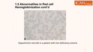 1.5 Abnormalities in Red cell
Hemoglobinization cont’d
42
Hypochromic red cells in a patient with iron-deficiency anemia
 