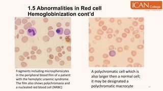 1.5 Abnormalities in Red cell
Hemoglobinization cont’d
47
Fragments including microspherocytes
in the peripheral blood film of a patient
with the hemolytic uraemic syndrome.
The film also shows polychromasia and
a nucleated red blood cell (NRBC)
A polychromatic cell which is
also larger then a normal cell;
it may be designated a
polychromatic macrocyte
 