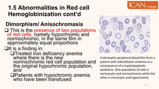 1.5 Abnormalities in Red cell
Hemoglobinization cont’d
Dimorphism/ Anisochromasia
 This is the presence of two populations
of red cells, namely hypochromic and
normochromic, in the same film in
approximately equal proportions
It is a finding in:
Treated iron deficiency anemia
where there is the new
normochromic red cell population and
the original hypochromic population,
and
Patients with hypochromic anemia
who have been transfused
48
A dimorphic peripheral blood film from a
patient with sideroblastic anaemia as a
consequence of a myelodysplastic
syndrome. One population of cells is
normocytic and normochromic while the
other is microcytic and hypochromic
 