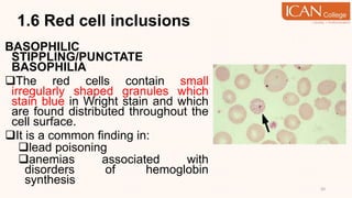 1.6 Red cell inclusions
BASOPHILIC
STIPPLING/PUNCTATE
BASOPHILIA
The red cells contain small
irregularly shaped granules which
stain blue in Wright stain and which
are found distributed throughout the
cell surface.
It is a common finding in:
lead poisoning
anemias associated with
disorders of hemoglobin
synthesis
50
 