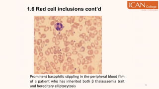 1.6 Red cell inclusions cont’d
51
Prominent basophilic stippling in the peripheral blood film
of a patient who has inherited both β thalassaemia trait
and hereditary elliptocytosis
 