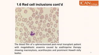 1.6 Red cell inclusions cont’d
54
The blood film of a splenectomized post-renal transplant patient
with megaloblastic anaemia caused by azathioprine therapy
showing macrocytosis, acanthocytes and prominent Howell–Jolly
bodies
 