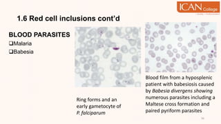 1.6 Red cell inclusions cont’d
BLOOD PARASITES
Malaria
Babesia
56
Ring forms and an
early gametocyte of
P. falciparum
Blood film from a hyposplenic
patient with babesiosis caused
by Babesia divergens showing
numerous parasites including a
Maltese cross formation and
paired pyriform parasites
 