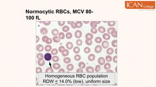 Normocytic RBCs, MCV 80-
100 fL
Homogeneous RBC population
RDW < 14.0% (low), uniform size
 