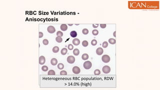 RBC Size Variations -
Anisocytosis
Heterogeneous RBC population, RDW
> 14.0% (high)
 