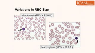 Variations in RBC Size
Microcytosis (MCV < 82.0 fL)
Macrocytosis (MCV > 98.0 fL)
 