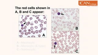The red cells shown in
A, B and C appear:
A - Macrocytic
B - Microcytic (& hypo)
C - Normocytic
A
B
C
 