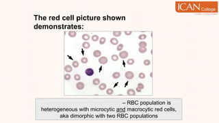 The red cell picture shown
demonstrates:
Anisocytosis with high RDW – RBC population is
heterogeneous with microcytic and macrocytic red cells,
aka dimorphic with two RBC populations
 