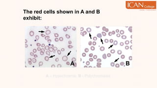 The red cells shown in A and B
exhibit:
A – Hypochromia, B - Polychromasia
B
A
 