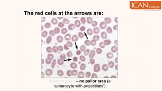 The red cells at the arrows are:
Acanthocytes – no pallor area (a
‘spherocyte with projections’)
 