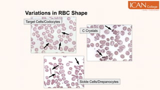 Variations in RBC Shape
Target Cells/Codocytes
C Crystals
Sickle Cells/Drepanocytes
 