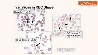 Variations in RBC Shape
C crystal Hgb C
SC crystals 
Hgb S & Hgb C
Sickle Cells  Hgb S
Note the target cells
 