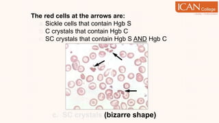 The red cells at the arrows are:
a.Sickle cells that contain Hgb S
b.C crystals that contain Hgb C
c. SC crystals that contain Hgb S AND Hgb C
c. SC crystals (bizarre shape)
 
