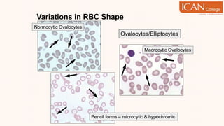 Variations in RBC Shape
Pencil forms – microcytic & hypochromic
Ovalocytes/Elliptocytes
Normocytic Ovalocytes
Macrocytic Ovalocytes
 