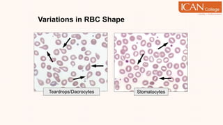 Variations in RBC Shape
Stomatocytes
Teardrops/Dacrocytes
 