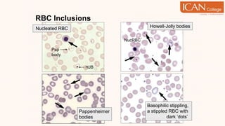 RBC Inclusions
Basophilic stippling,
a stippled RBC with
punctate dark ‘dots’
Howell-Jolly bodies
Pappenheimer
bodies
NucRBC
Nucleated RBC
HJB
Pap
body
 