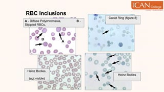 RBC Inclusions
B
A
A - Diffuse Polychromasia, faint ‘dots’ B -
Stippled RBCs, punctate ‘dots’
Cabot Ring (figure 8)
Supravital stain
Heinz Bodies,
Wright’s stain
(not visible)
Heinz Bodies
Supravital stain
 