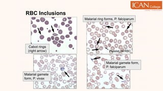 RBC Inclusions
Malarial gamete
form, P. vivax
Malarial gamete form,
P. falciparum
Malarial ring forms, P. falciparum
Platelet on RBC
Cabot rings
(right arrow)
 