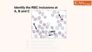 Identify the RBC inclusions at
A, B and C
A – Basophilic stippling
B – Howell-Jolly body
C – Pappenheimer bodies
B
C
A
 