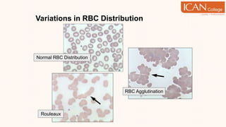 Variations in RBC Distribution
Rouleaux
RBC Agglutination
Normal RBC Distribution
 