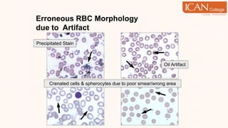 Erroneous RBC Morphology
due to Artifact
Oil Artifact
Precipitated Stain
Crenated cells & spherocytes due to poor smear/wrong area
 