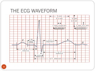 THE ECG WAVEFORM
20
 