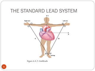 THE STANDARD LEAD SYSTEM
31
Figure.6.4.2: Limbleads
 