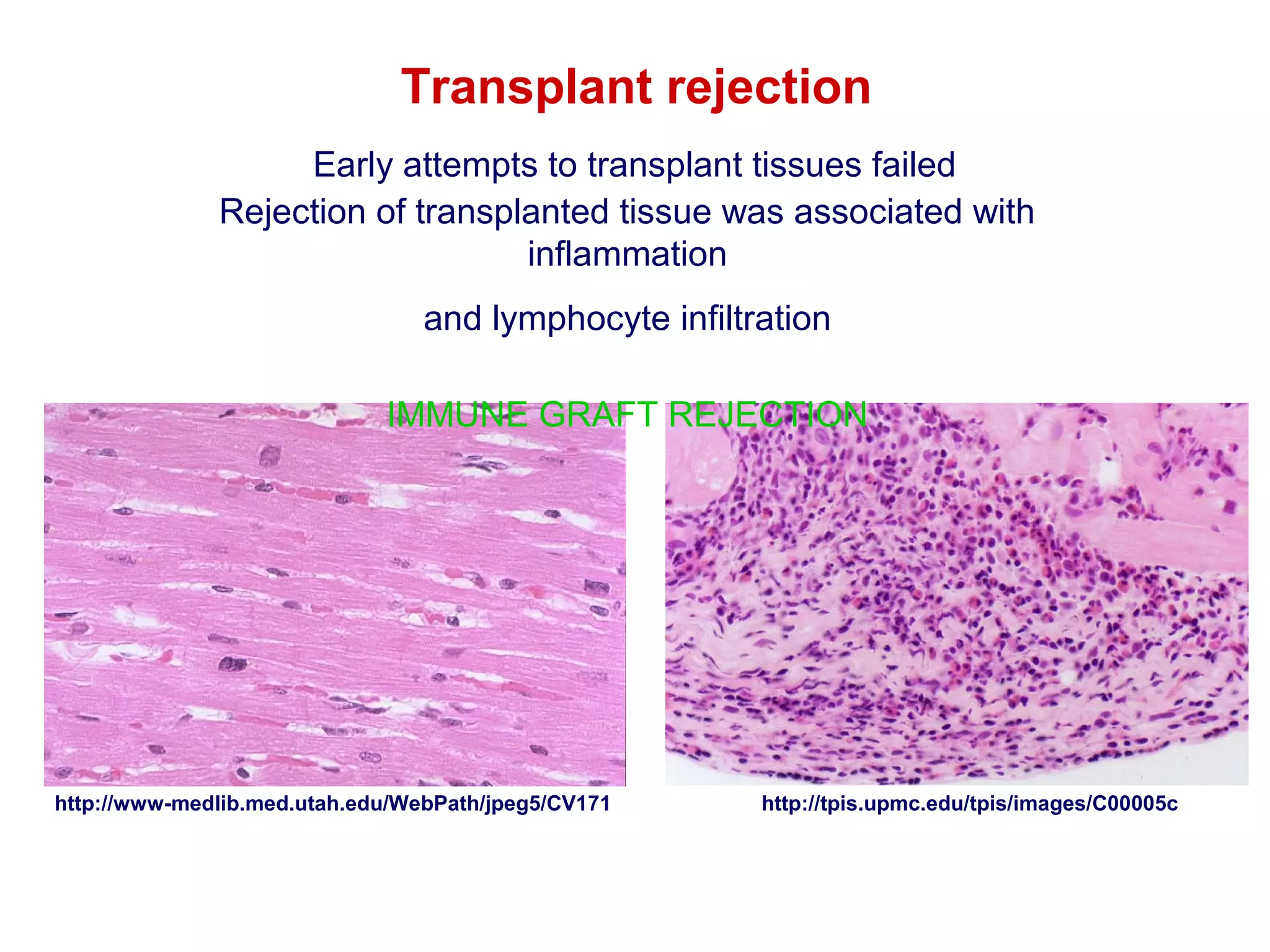Transplant rejection
Early attempts to transplant tissues failed
Rejection of transplanted tissue was associated with
inflammation
and lymphocyte infiltration
IMMUNE GRAFT REJECTION

http://www-medlib.med.utah.edu/WebPath/jpeg5/CV171

http://tpis.upmc.edu/tpis/images/C00005c

 