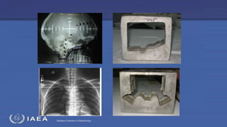 Radiation Protection in Radiotherapy
 