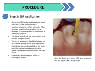 TOPICAL APPLICATION FLUORIDE.pptx