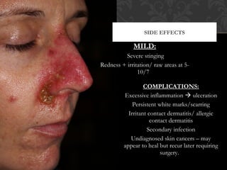 Topical chemo therapeutic treatments for non melanoma skin cancer | PPT