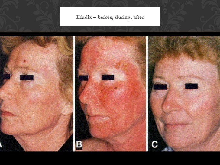 Skin Cancer Treatment Before And After