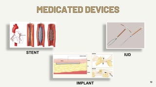 MEDICATED DEVICES
10
STENT
IMPLANT
IUD
 